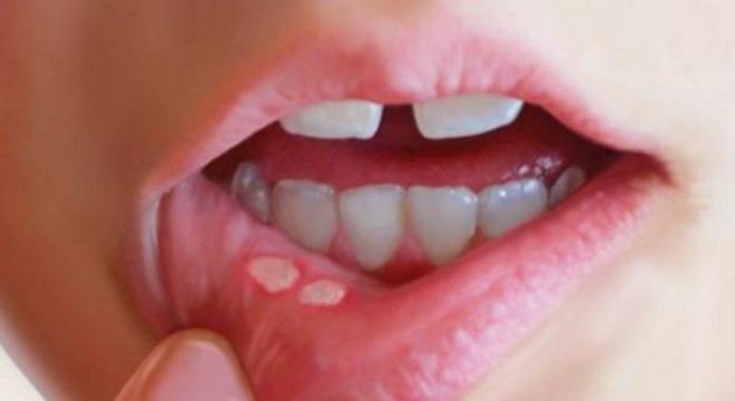 Cách chữa nhiệt miệng tại nhà cho bé hiệu quả